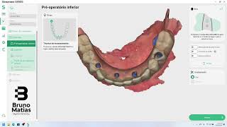 Straumann Sirios - Full arch Scan @StraumannGlobal