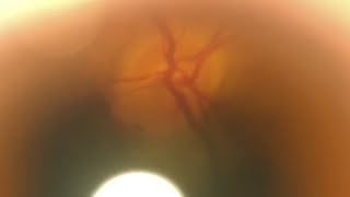 Smartphone Direct Ophthalmoscopy: Peripapillary Hemorrhages