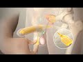 penile implants for erectile dysfunction dr. sanjay razdan