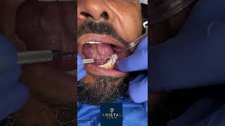 Teeth Cleaning: The Sparkling Transformation | Dental Short #15