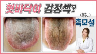 혓바닥 색깔이 검은색으로 보여요! 혀 백태가 검게 변하는 흑모설 원인은?