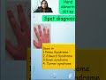 hand abnormalities in pediatrics short 4th metacarpal image based diagnosis osce spot shorts