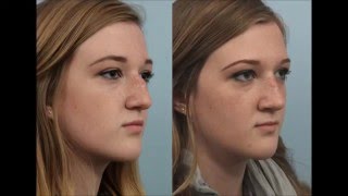 Rhinoplasty by Dr. Edwin Williams