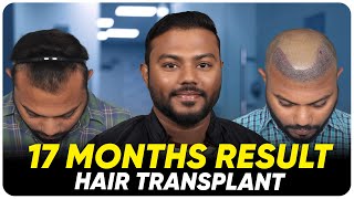 Hair Transplant in Hubli | Best Results \u0026 Cost of Hair Transplant in Hubli