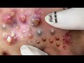 Big Cystic Acne Blackheads Extraction Blackheads & Milia, Whiteheads Removal Pimple Popping # 1240