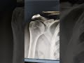 how to read normal shoulder x ray..dr sai chandra mbbs dnb ortho