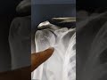 How To Read Normal Shoulder X Ray..Dr Sai Chandra MBBS DNB (Ortho)