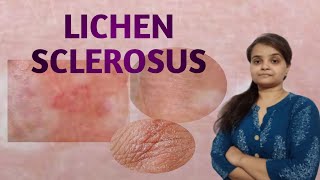 LICHEN SCLEROSUS