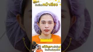 รีวิวร้อยไหมหน้าเรียว แก้ปัญหาแก้มห้อยใบหน้าหย่อนคล้อย