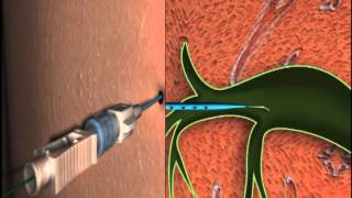 Bile Ducts--DIRECT ACCESS+GW METHOD (Drainge catheter without safety string lock).mpe