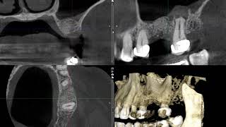 Odontogenic sinusitis