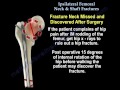 Ipsilateral Femoral  Neck & Shaft Fractures - Everything You Need To Know - Dr. Nabil Ebraheim