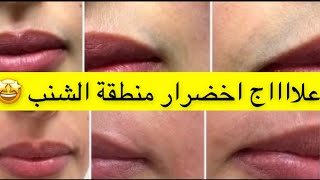 علاج اخضرار منطقة الشنب نهااااية المشكله والحل سهل وبسيط ونتيجه سرييييييعه