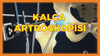 KALÇA ARTROSKOPİSİYLE HANGİ TEDAVİLER YAPILIR?