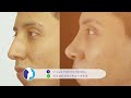 rinoseptoplastÍa nariz grande y desviada 👃🏼 rinoplastÍa estética y funcional ❤️ dr percy nevado