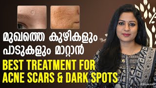 മുഖത്തെ കുഴികളും പാടുകളും മാറ്റാൻ Best treatment for Acne Scars \u0026 dark spots | Remove acne scars