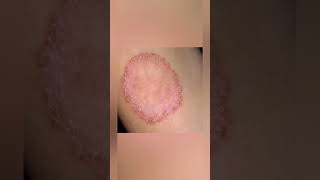 Ring worm infection Cure at Home Padar thamarai in Tamil #shorts #skincare