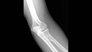 3 View Standard Elbow Radiology Tutorial