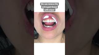 Laser gum contouring | laser gum treatment | Dr. Yazdan | small teeth to big teeth | gum lift
