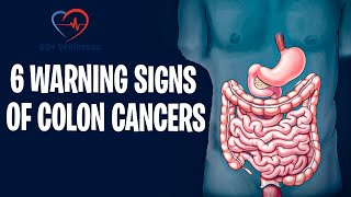 6 Warning Signs of Colon Cancer