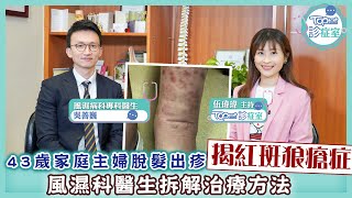 【TOPick診症室】43歲主婦脫髮出紅疹揭紅斑狼瘡症　風濕病科專科醫生拆解最新治療方法