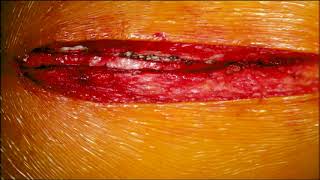 Off-Pump Single Vessel Coronary Artery Bypass (Mahesh Ramchandani, MD, M. Mujeeb Zubair, MD)