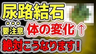 【衝撃】意外に知られていない、尿路結石ができる仕組みとは？予防法とは？【医師監修】