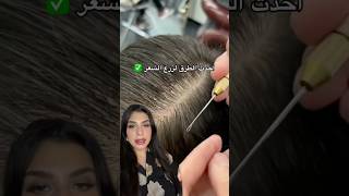 أحدث الطرق لزرع الشعر ✅