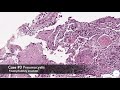 Pneumocystis pneumonia