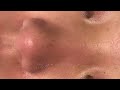 【韓国式3d毛穴洗浄】毛穴の角栓黒ずみをごっそり吸引 asmr blackheads