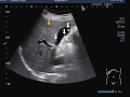 Ultrasound Video showing multiple polyps in the gall bladder.