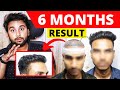 Is This The Best Hairline Clinic In Delhi? 6 Months Hair Transplant Result Timeline In India