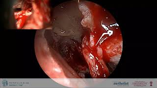 Resection of Vestibular Schwannoma via restrosigmoid mini-craniotomy: Minimally Invasive Surgery