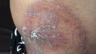 Fungal Infection in Private parts | Not Curing | Do's and Don'ts |படர்தாமரை குணமாக டிப்ஸ்| Dr.Selvin