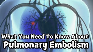 What you need  to know about Pulmonary Embolism!