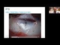 Live Clinical Case Discussion: Pediatric Cataract and Glaucoma