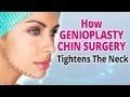 How Genioplasty CHIN SURGERY Tightens The Neck