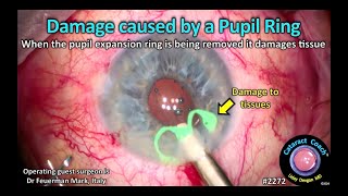 CataractCoach™ 2272: damaged caused by a pupil expansion ring