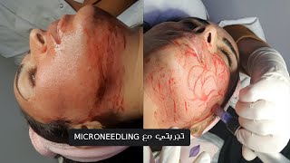 في سطات MICRONEEDLING   تجربتي مع