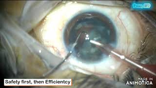 Safe and Efficient in cataract surgery