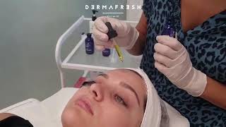 Peeling \u0026 Φωτοδυναμική θεραπεία κατά της ακμής - Dermafresh Clinic