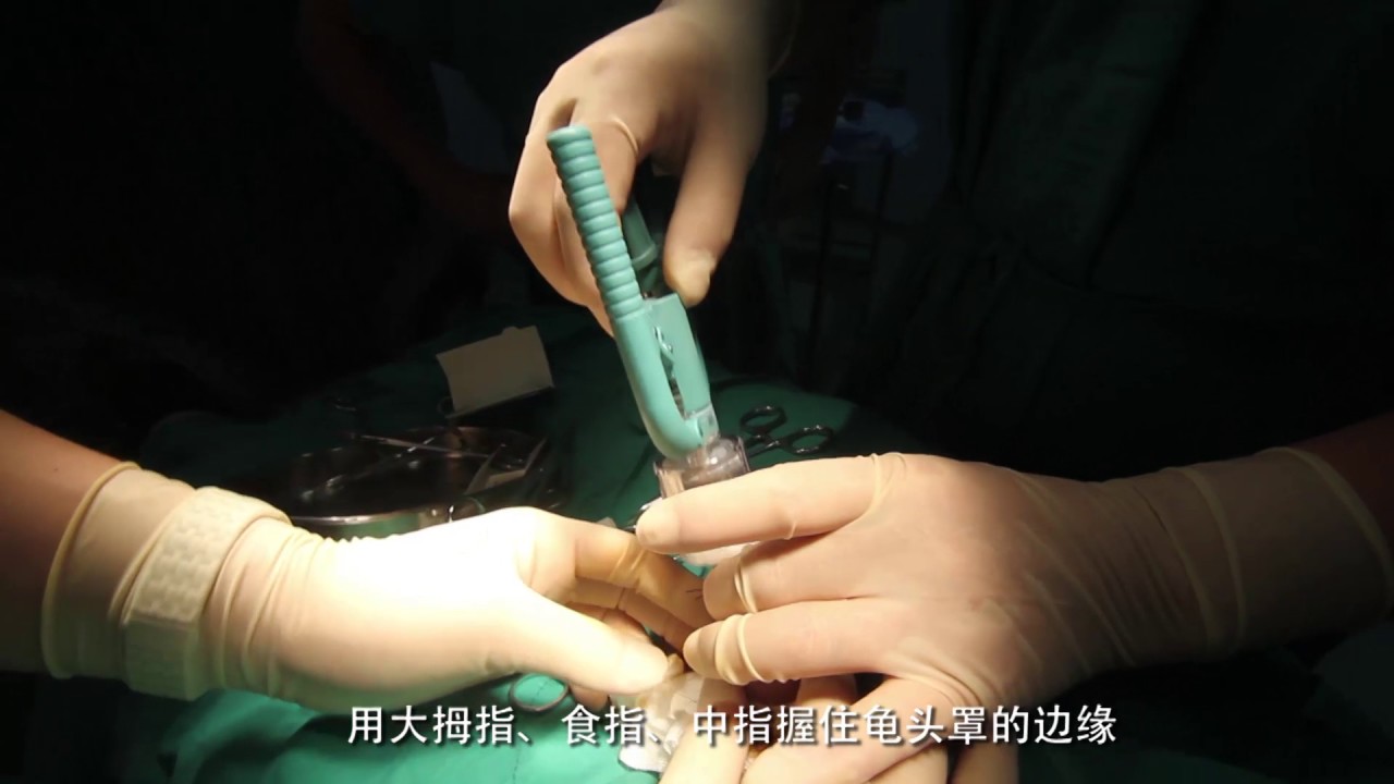 Circumcision Procedure Steps Circumcision Procedure Steps