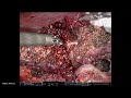 robotic hepatectomy segment 6