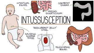 Understanding Intussusception