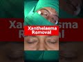 xanthelasma removal treatment at shobhit aesthetics