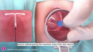 Inserting AVIBELA hormonal IUD (English)