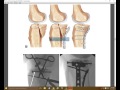 Tibial plateau book chapter review