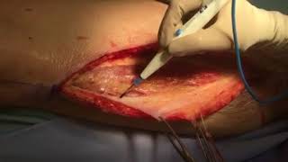 A Practical Guide to the Use of the Anterolateral Thigh Flap