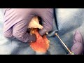 Cyst (Quinoa) Removal Pops and Almost Hits Camera Lens