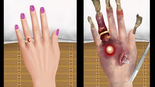 ASMR Removal athlete's fungal foot warts for the mascot at home | Treatment animation